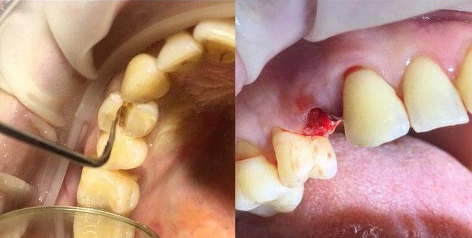 Удаление сложного зуба пример 2