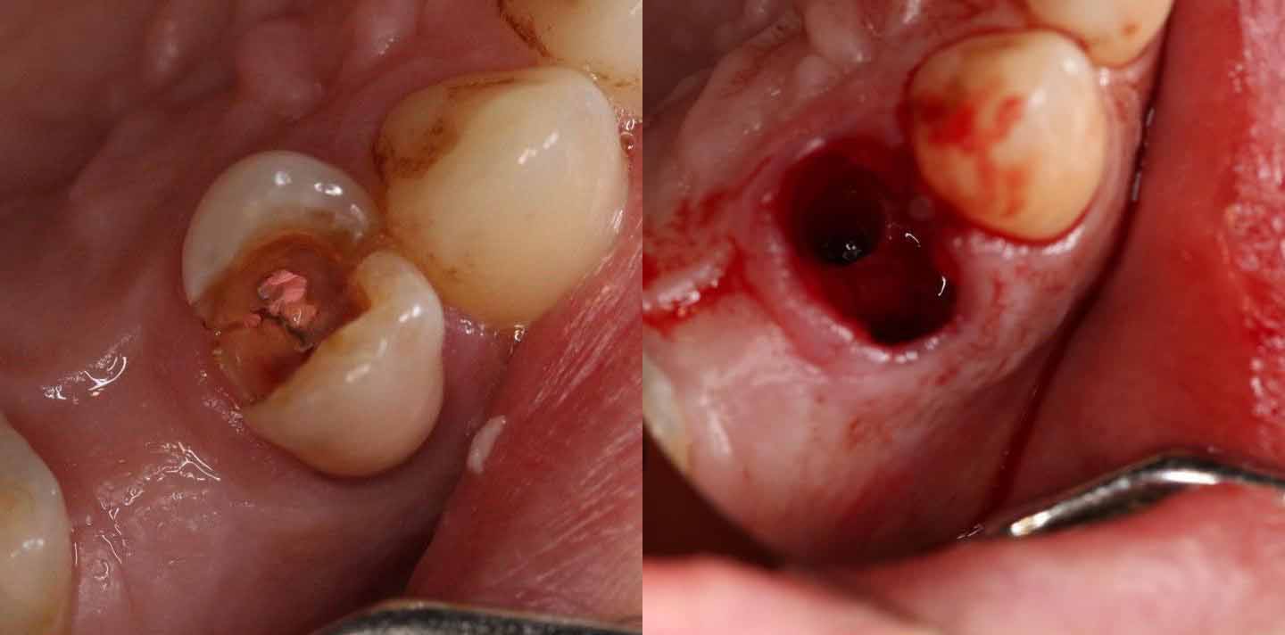 Почему опасно оставлять в десне корень зуба?