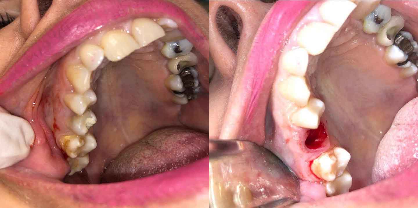 Удаление сложного зуба пример 4