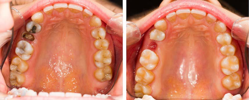 Удаление сложного зуба пример 5