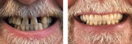 Зубные протезы пример 3