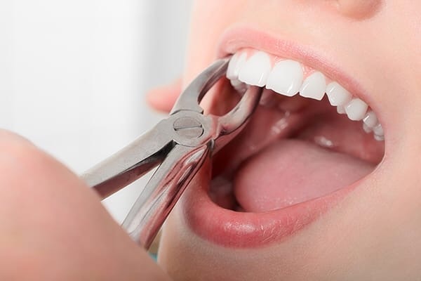удаление молочного зуба