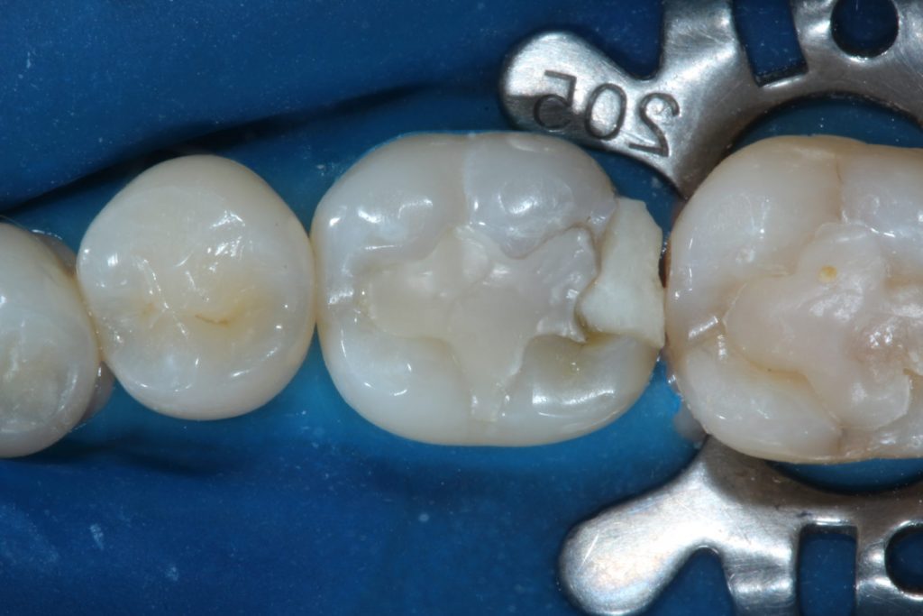 Восстановление целостности зуба: плюсы и минусы